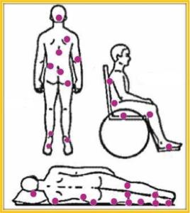 Úlceras por presión